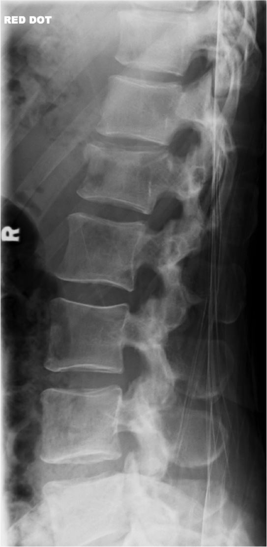 the-thoracolumbar-spine